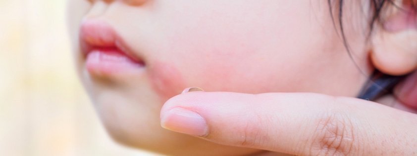 /on/demandware.static/-/Library-Sites-MultipharmaSharedLibrary/default/dwf0f310a6/Home/blog/Goed in mijn vel/impetigo-behandelen.jpg